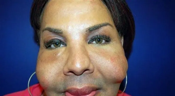 Muestran rostro de mujer deformado por cirugías estéticas