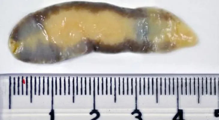 Trematodiasis: una enfermedad que puede infectar verduras, pescados y mariscos y que mata a 7 mil personas cada año