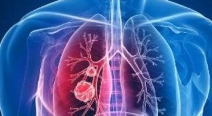 Demuestran que un gen del cáncer común también causa malformaciones venosas
