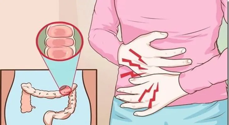 Ella logró terminar con la Gastritis y Colitis con un sólo Remedio, mira como lo hizo