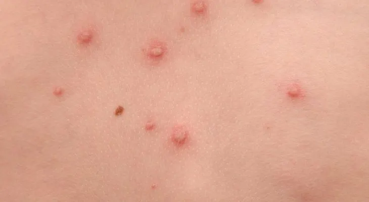 Casos de varicela pueden aumentar por falta de vacunas
