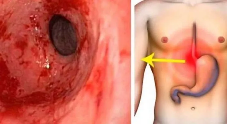 Elimina la gastritis y la acidez estomacal de por vida con este eficaz remedio