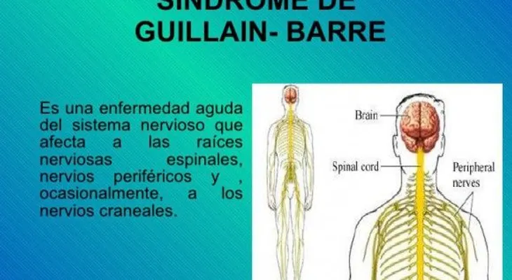 Mueren dos personas de Guillan Barré