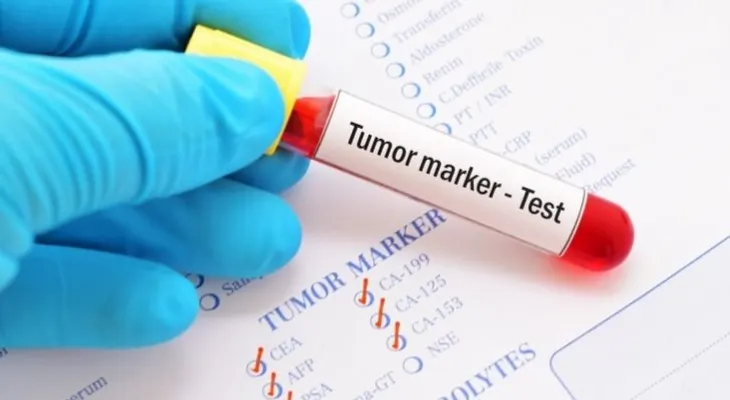 Desarrollan un examen de sangre que revela ocho tipos de cáncer