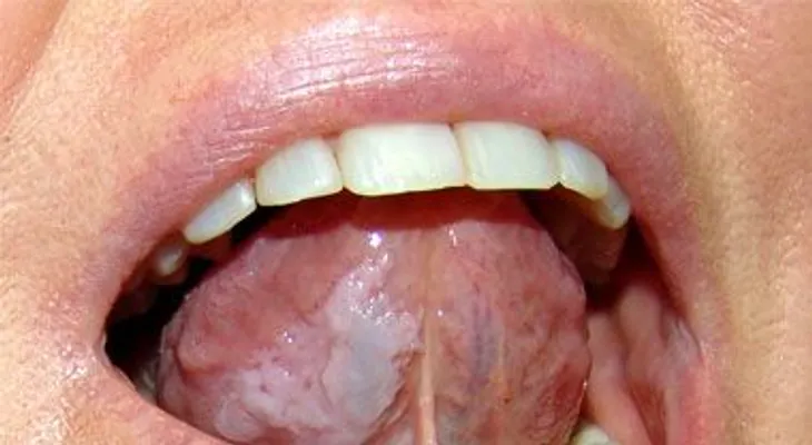 9 señales de tu lengua sobre problemas en su salud que no puedes ignorar