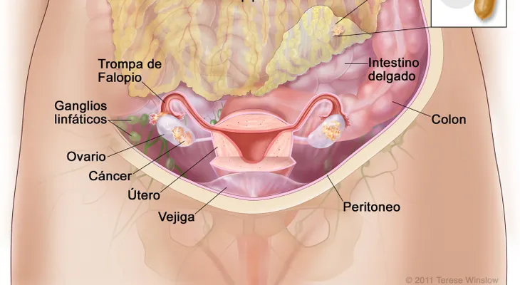El cáncer de ovarios tiene mayor presencia en mujeres con endometriosis; una infección que afecta ovarios, trompas de Falopio y pelvis