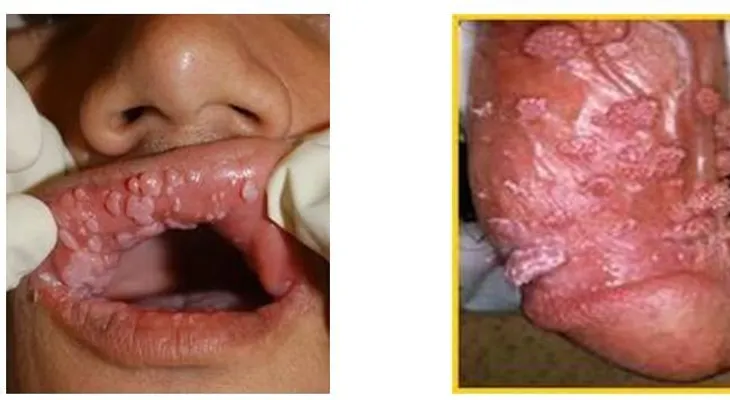 Condilomas genitales, causas y tratamientos