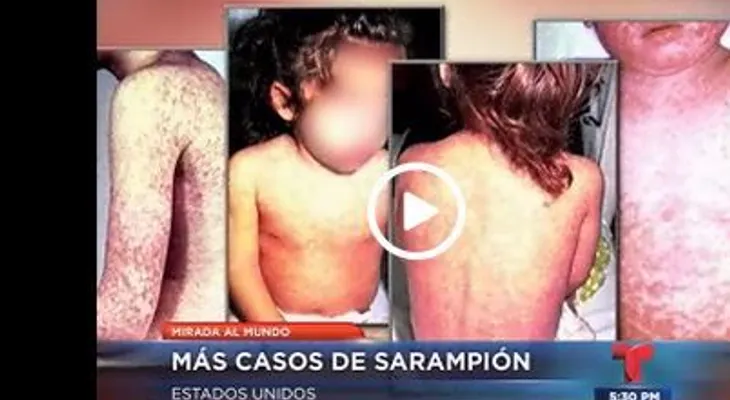 Casos de sarampión en aumento