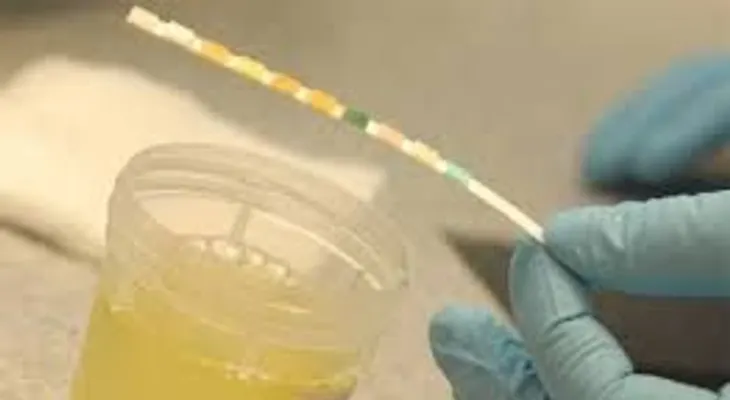 Un color turbio en la orina puede ser síntoma de una infección