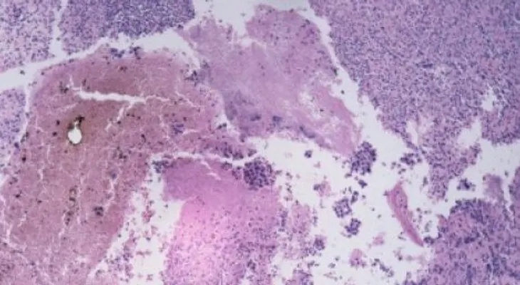 ¿Por qué el cáncer vuelve?