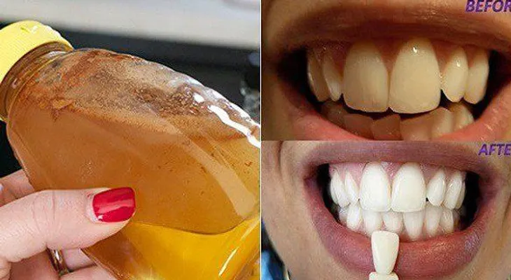 Haga gárgaras con un simple ingrediente y sucederá algo increíble en tus dientes
