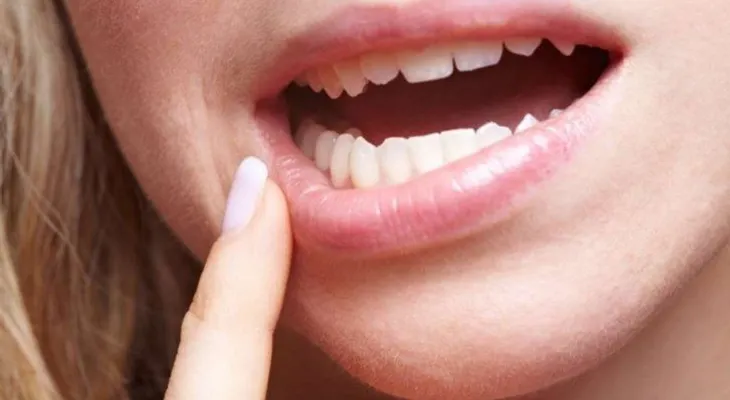 5 consejos para evitar aftas