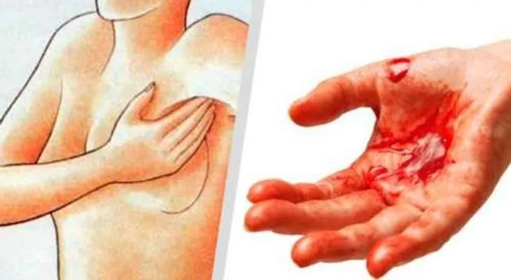 Si tiene la cara hinchada, cambios en el pezón, dolor de pecho y tos crónica, puede tener cáncer. CUIDATE 