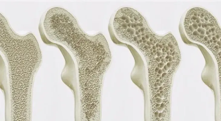 Usar bisfosfonatos para osteoroporosis aumenta el riesgo en enfermedad renal