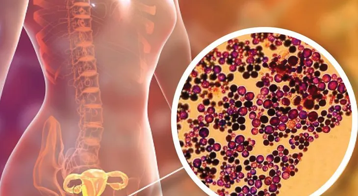Ginecóloga Liliam Fondeur recomienda a mujeres con infección vaginal dormir sin ropa interior