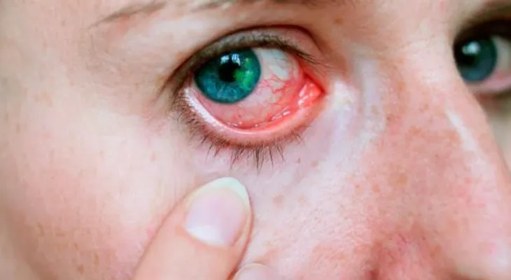 La abrasión o úlcera corneal