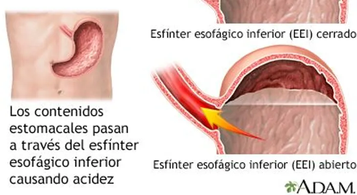 Enfermedad por reflujo gastroesofágico