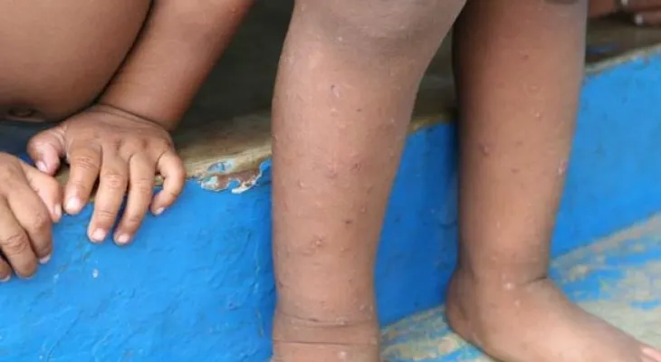 ¡Ojo! Repuntan casos de sarna por escasez de agua y jabón