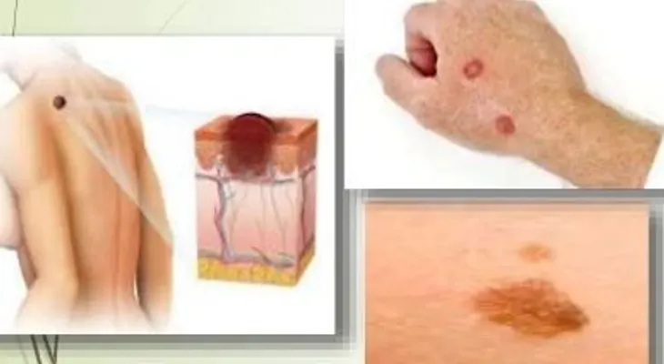 Recomiendan usar filtros solares para evitar el cáncer de la piel, que va en aumento en el país