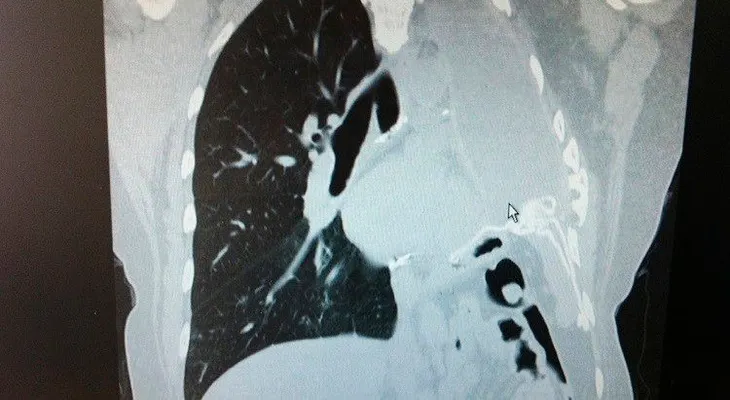"Asesino invisible": un gas en muchos hogares podría causar cáncer de pulmón