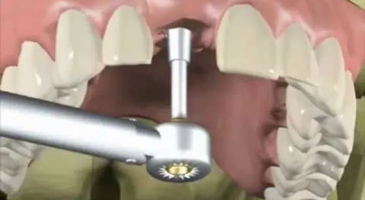 ¿Como se hace la prótesis sobre implantes dentales?