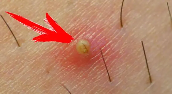 7 soluciones naturales para eliminar los pelos enquistados