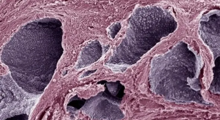 La vitamina D limita la agresividad del cáncer de próstata