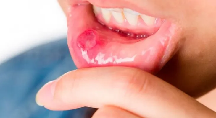 Un fármaco para tratar la psoriasis, demuestra ser muy eficaz en las úlceras orales 