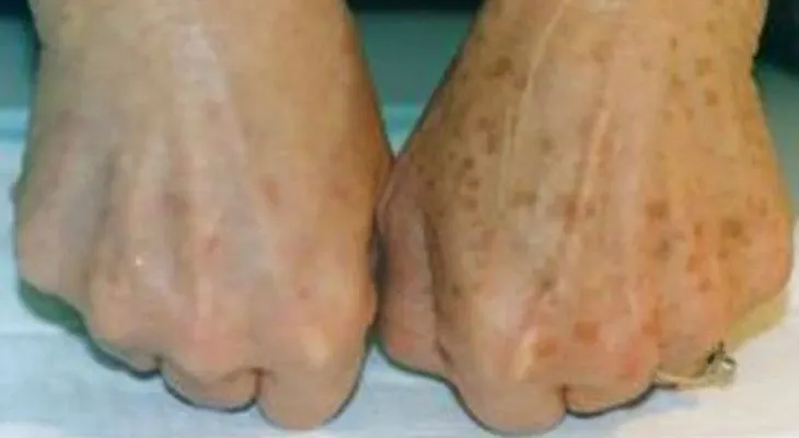 Esta crema quita las manchas desde su segundo uso, fácil, rápido y barato! 