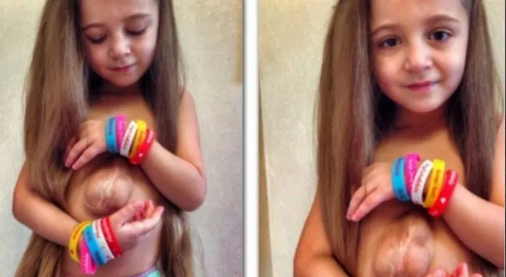 El extraño caso: niña que nació con el corazón por fuera del pecho