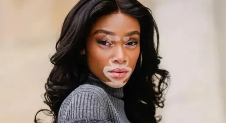 El vitiligo es una enfermedad de la piel que se desarrolla a partir de los 20 años; mayormente en las mujeres
