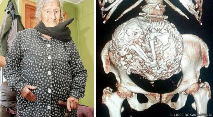 Una anciana tiene 60 años con un feto en su vientre 