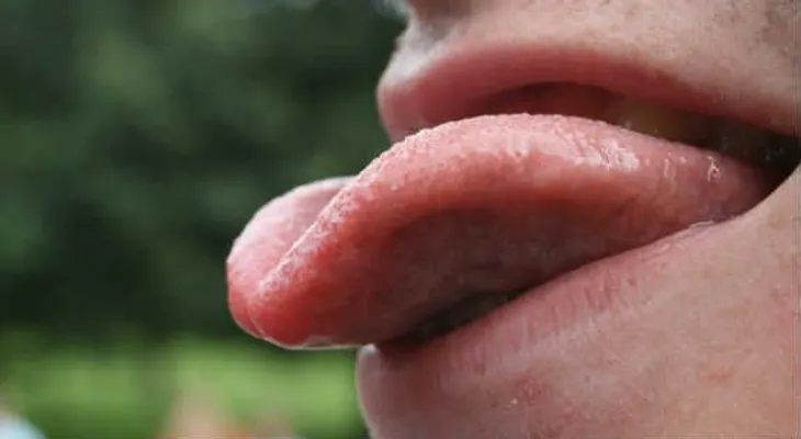 ¿Podría una lengua gorda ser un factor en la apnea del sueño?
