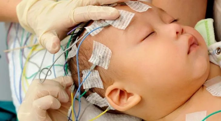 El síndrome de West, una enfermedad rara que afecta a unos 800 niños en Perú