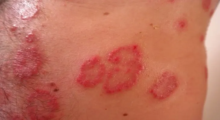La psoriasis y sus formas de tratamiento: ácido salicílico y alquitrán de hulla