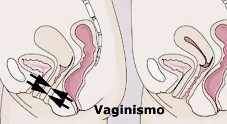 El vaginismo afecta a un 5% de las mujeres e impide que muchas parejas puedan tener sexo 
