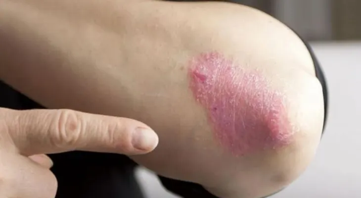 Artritis psoriática: Dolor articular debe ser tomado en serio
