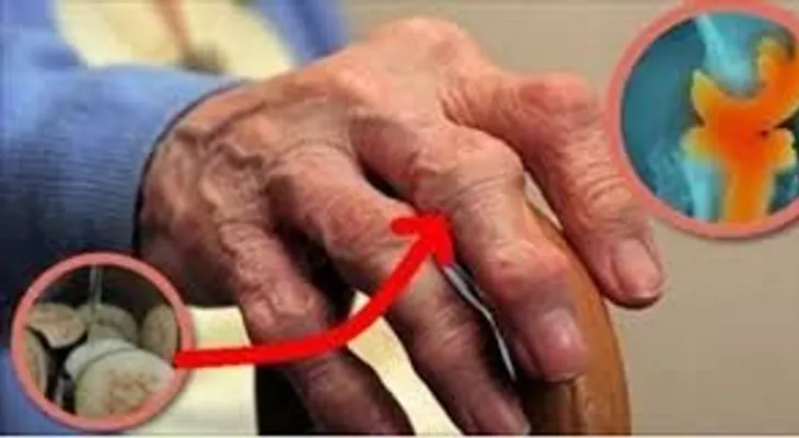 Antes de intentar este remedio, ella no podía ni levantarse por el dolor agonizante en las articulaciones!
