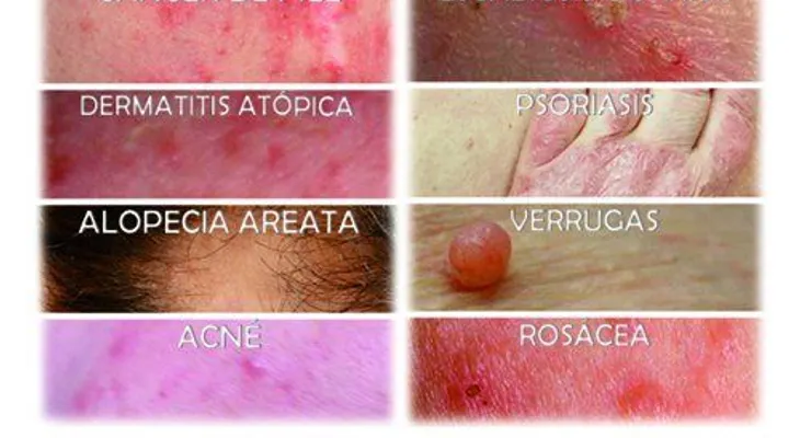 Más de 600 mil pacientes acuden anualmente al Dermatológico por enfermedades de la piel