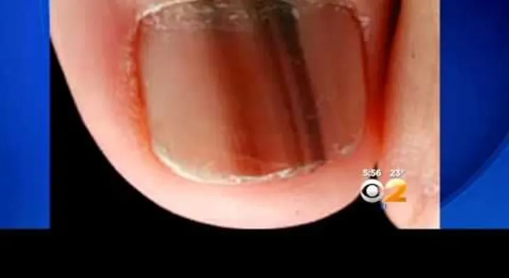 Si encuentras esta línea negra en tus uñas, esto es lo que significa! (VIDEO)