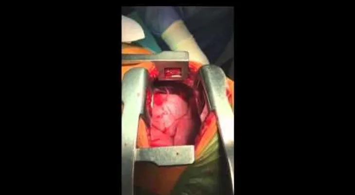 No apto para sensibles: Le sacan una espada clavada en el corazón (VIDEO)