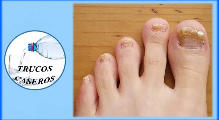 Fabrica tu propio "rompe hongos" para las uñas: Sorprendente resultado