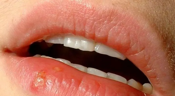 Primeros síntomas del herpes simple... ¿cómo controlarlo?