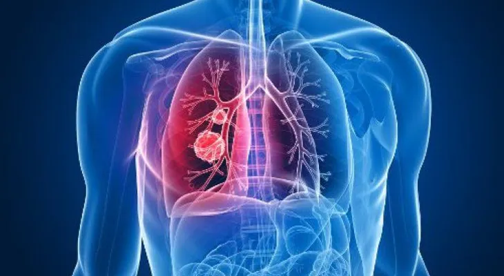 6 posibles causas de cáncer de pulmón que seguro no conocías
