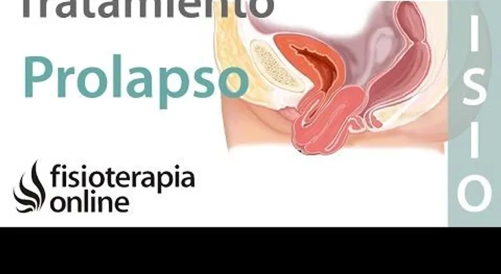 Tratamiento para el prolapso en el suelo pélvico 