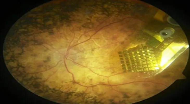 Por 100 mil euros implantan en Francia chips devuelve la visión a paciente ciego