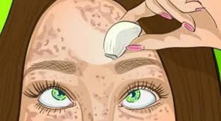 Manchas en la cara: El mejor remedio. La mejor solución