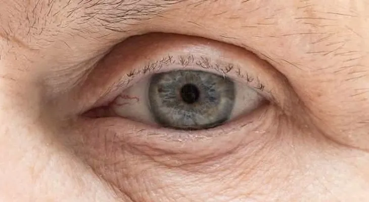 Las causas del derrame ocular y como tratarlo naturalmente