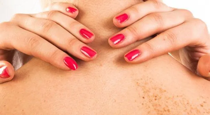 Qué son las pecas y cómo cuidarlas correctamente