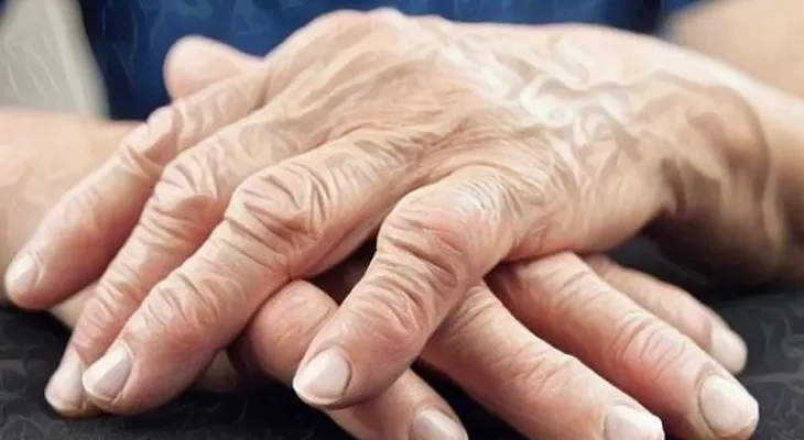 Factores que te ponen en riesgo de desarrollar artritis reumatoide